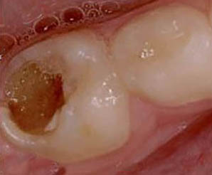 молочные зубы до лечения